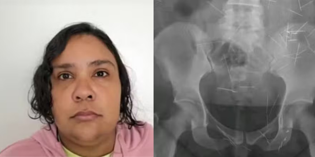 Mulher de 37 anos 'adotada' após fingir ter 12 anos procurou hospital infantil em 2023 com agulhas no corpo
