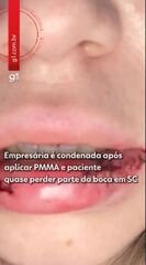 Empresária condenada após complicações em procedimento estético com PMMA em SC